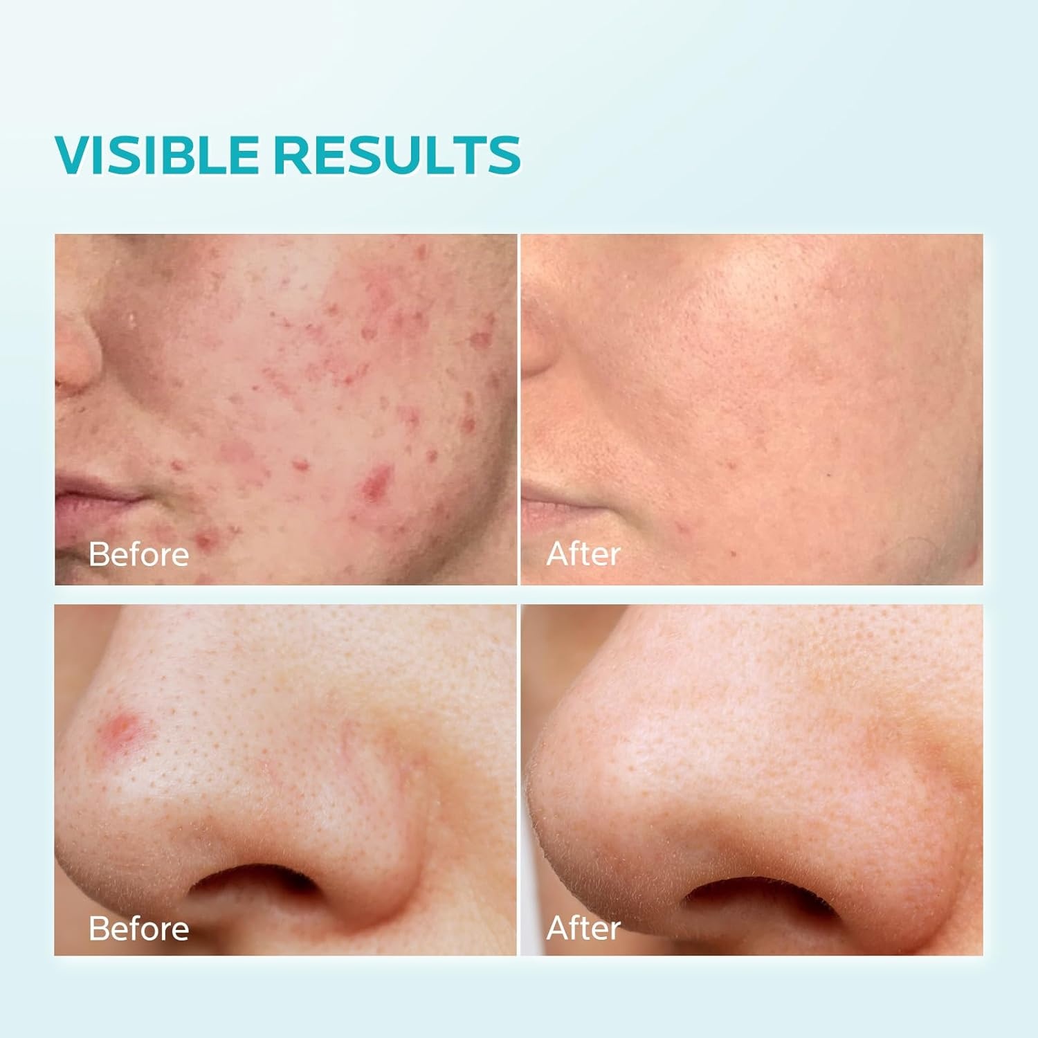 image:imageZealSea 10 Azelaic Acid Facial Cream Azelaic Acid Serum with Niacianmide amp Pionin for Face Relief Pimple Breakouts Blackhead amp Redness Azelaic Acid Gel Clarify Skin Soothe Irritation 1 Oz1 Fl Oz Pack of 1
