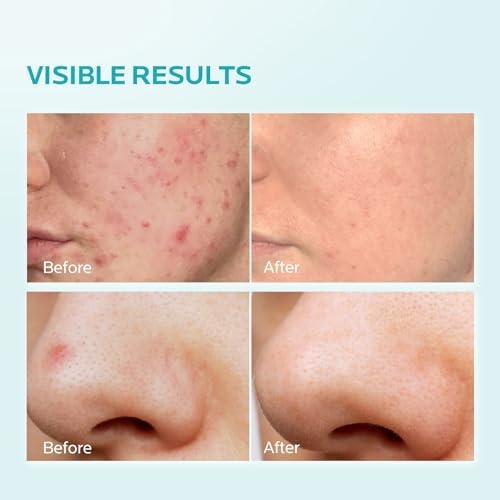 image:imageZealSea 10 Azelaic Acid Facial Cream Azelaic Acid Serum with Niacianmide amp Pionin for Face Relief Pimple Breakouts Blackhead amp Redness Azelaic Acid Gel Clarify Skin Soothe Irritation 1 Oz034 Ounce Pack of 1