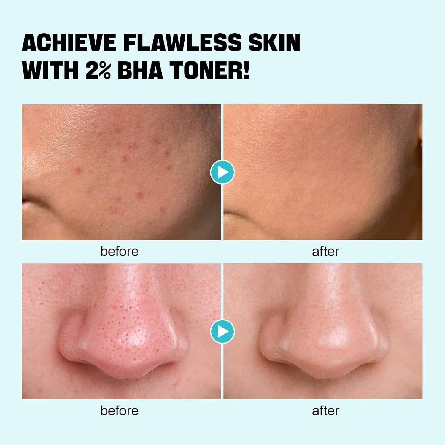 image:imageZealSea Salicylic Acid Toner Blackhead Remover BHA Liquid Exfoliant CICA 676OZ Pore Minimizer for Face Gentle Alcohol Free BHA Toner for All Skin Type with Niacinamide Redness Relief VeganBHA 676 FLOZPack of 2